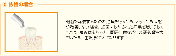 抜歯の場合