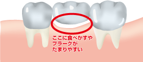 ここに食べかすや
プラークが
たまりやすい