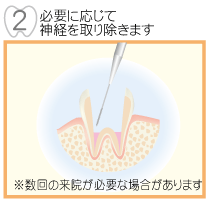 必要に応じて神経を取り除きます