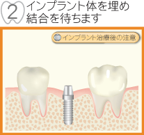 インプラント体を埋め結合を待ちます