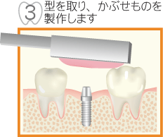 型を取り、かぶせものを製作します