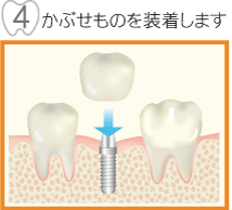 かぶせものを装着します